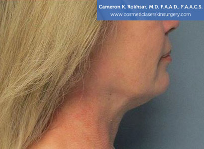 Female face, Photo - After Liposuction Treatment, side view, patient 29