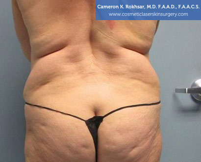 Female back, Photo - Before Liposuction Treatment, rear view, patient 28