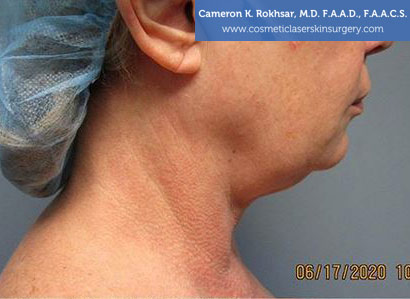 Female face, Photo - Before Liposuction Treatment, side view, patient 29