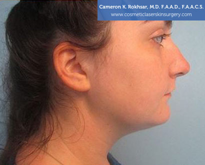 Female face, Photo - After Liposuction Treatment, side view, patient 1