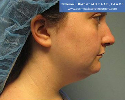 Female face, Photo - Before Liposuction Treatment, side view, patient 1