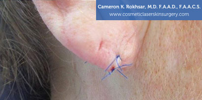 Female Earlobes, After Treatment photo, side view, patient 1