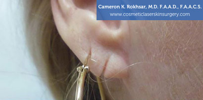 Female Earlobes, Before Treatment photo, side view, patient 1