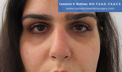 15 minute nosejob - After treatment photo, female, front view, patient 138
