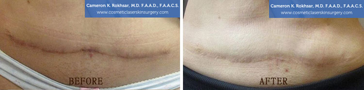 Scar Revision: Before and After Treatment Photo - patient 1