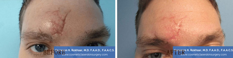 Scar Revision: Before and After Treatment Photo - patient 2