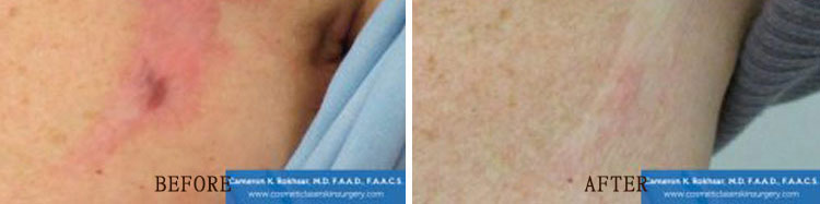 Scar Revision: Before and After Treatment Photo - patient 3