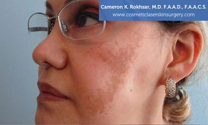 Woman's Face, Before Age/Brown Spots Treatment, oblique view, patient 1