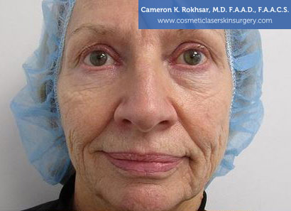 Woman's face, Before Fraxel Treatment photo, front view, patient 1