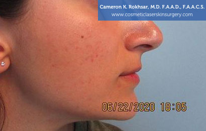 Woman's face, After Laser Acne Treatment photo, side view, patient 1