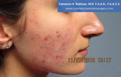 Woman's face, Before Laser Acne Treatment photo, side view, patient 1