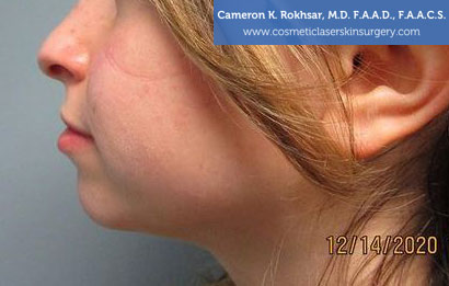 Non-Surgical photo: Before Chin Job Treatment, Female face, side view, patient 1
