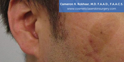 Birthmarks Before Treatment Photo - Patient
