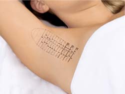 How it works - miraDry: A temporary tattoo is used to mark skin in preparation for treatment.