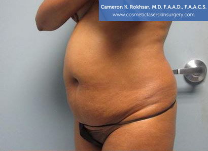 Liposuction Before Treatment Photo - Patient