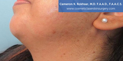 Laser Acne Treatment After Treatment Photo - Patient