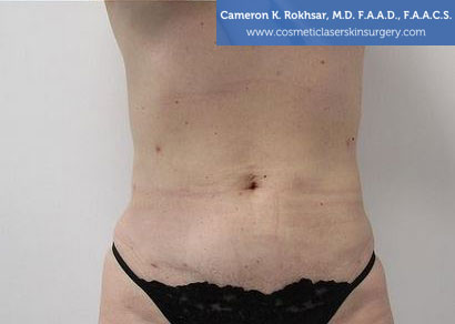 Liposuction After Treatment Photo - Patient