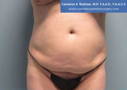 Liposuction Before Treatment Photo - Patient