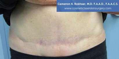 Scar Revisions After Treatment Photo - Patient