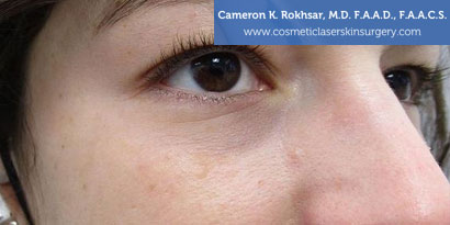 V-Beam After Treatment Photo - Patient