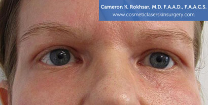 Non-Surgical Eye Lift After Treatment Photo - Patient