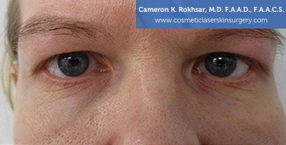 Non-Surgical Eye Lift Before Treatment Photo - Patient