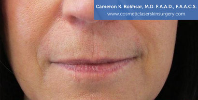 Lip Enhancement Before Treatment Photo - Patient