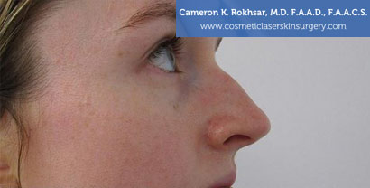 Non Surgical Nosejob Before Treatment Photo - Patient