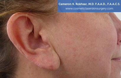 Earlobes After Treatment Photo - Patient
