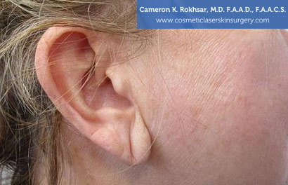 Earlobes Before Treatment Photo - Patient