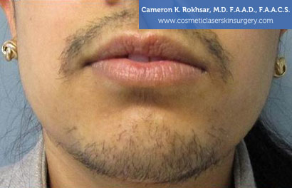 Laser Hair Removal Before Treatment Photo - Patient