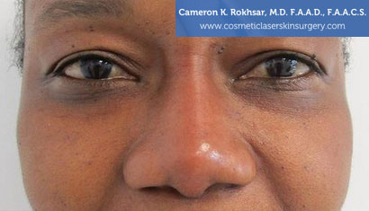 Non Surgical Nosejob After Treatment Photo - Patient