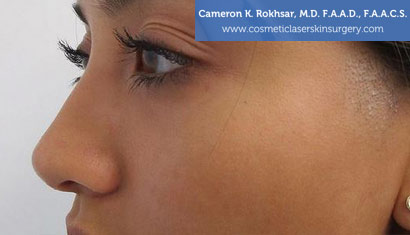 Non Surgical Nosejob  Treatment Photo - Patient