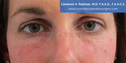 Non-Surgical Eye Lift After Treatment Photo - Patient