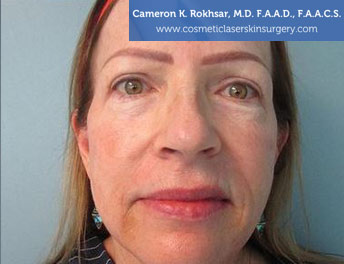 Age/Brown Spots After Treatment Photo - Patient