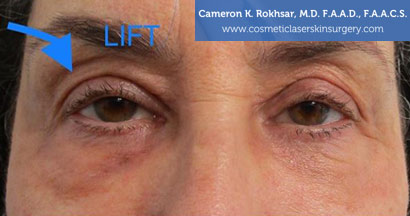 Blepharoplasty After Treatment Photo - Patient