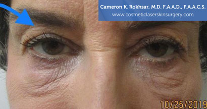 Blepharoplasty Before Treatment Photo - Patient