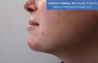 Non-Surgical Chin Job After Treatment Photo - Patient