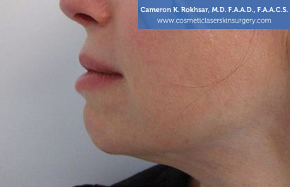 Non-Surgical Chin Job Before Treatment Photo - Patient