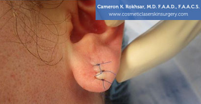 Earlobes After Treatment Photo - Patient