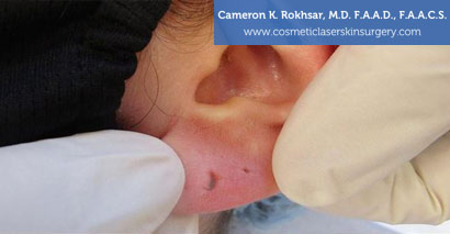 Earlobes Before Treatment Photo - Patient