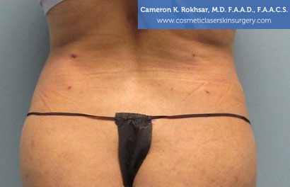Liposuction After Treatment Photo - Patient