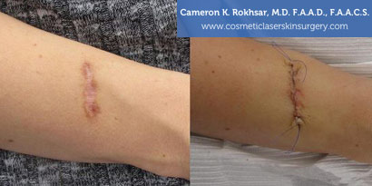 Birthmarks After Treatment Photo - Patient