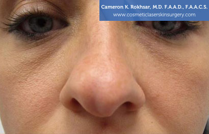 Non Surgical Nosejob Before Treatment Photo - Patient