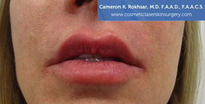 Lip Enhancement After Treatment Photo - Patient