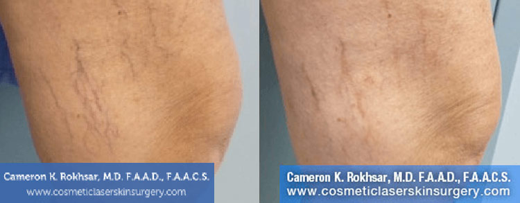 Sclerotherapy: Before and After Treatment Photo - patient 1