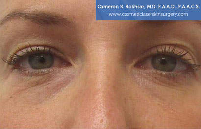 Non-Surgical Eye Lift Before Treatment Photo - Patient