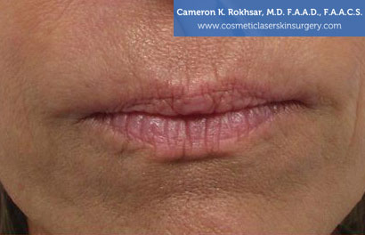Lip Enhancement Before Treatment Photo - Patient