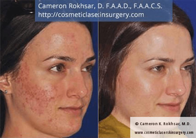 Microneedling: Before and After Treatment Photo - patient 1