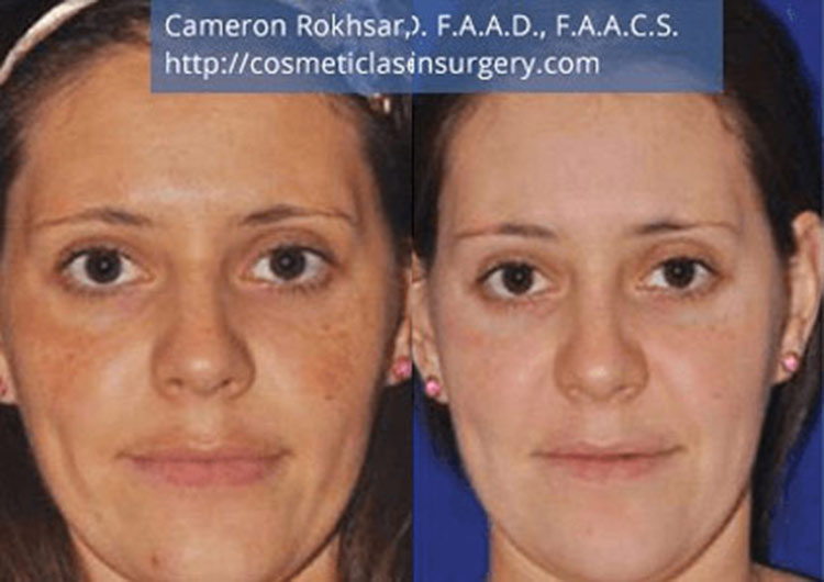 Microneedling: Before and After Treatment Photo - patient 2